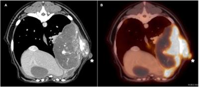 Potential Seeding From Fine-Needle Aspiration of an Axial Osteosarcoma: A Case Report